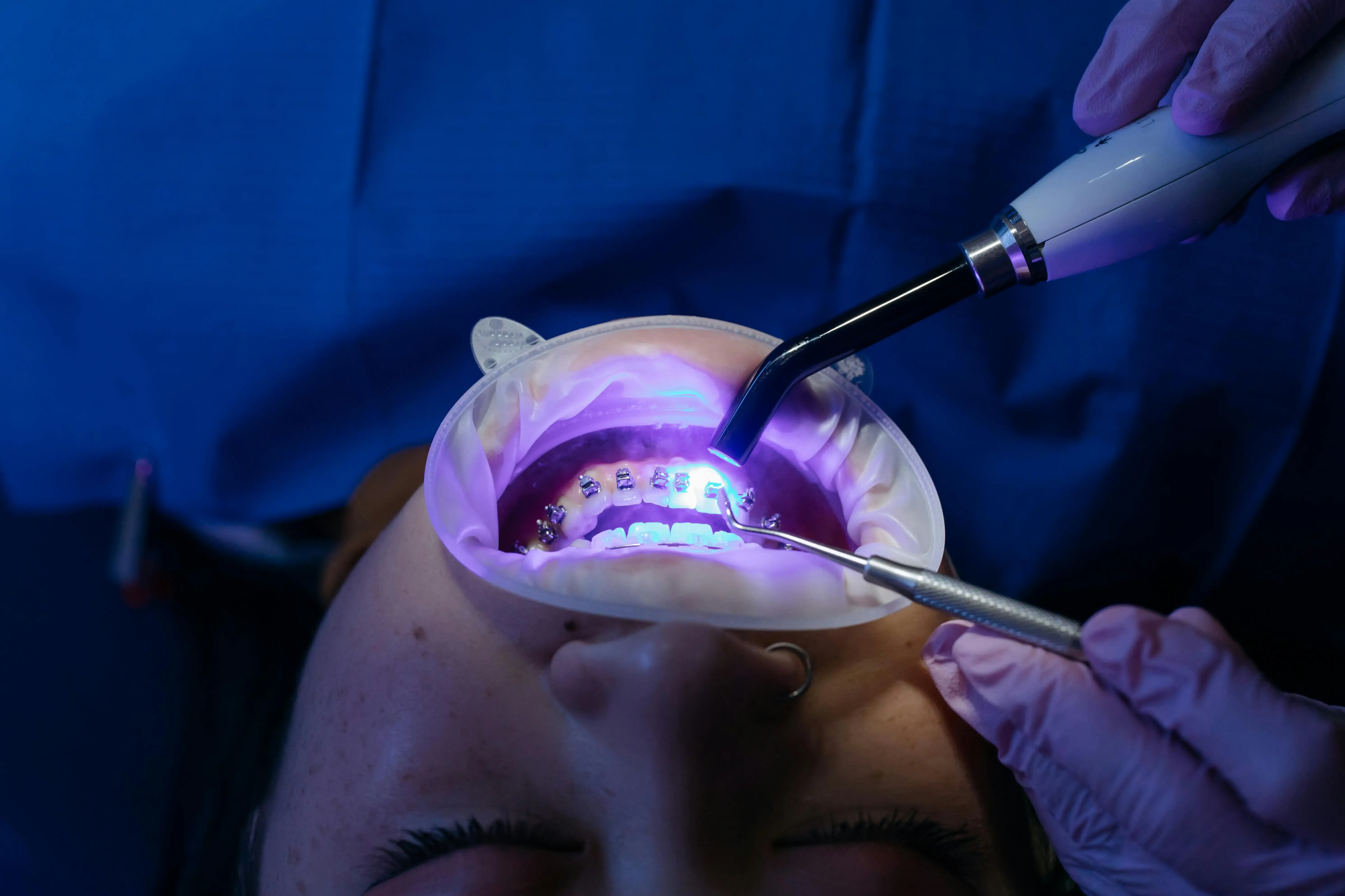 How to Keep a White Smile After Whitening